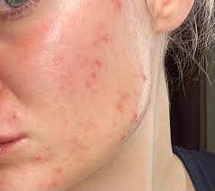 Nurturing Radiance: The Essence of Sensitive Face Care Products